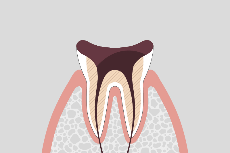 歯根まで進行したむし歯