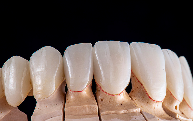 オールセラミック