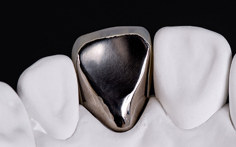 硬質レジン前装冠