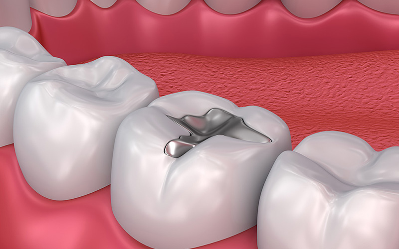 金銀パラジウム合金