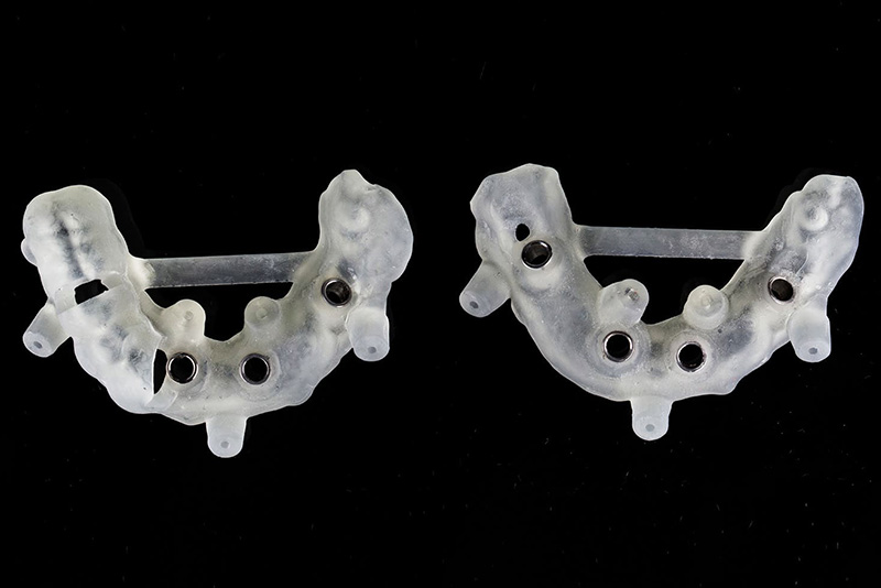 サージカルガイドを用いた安全な埋入