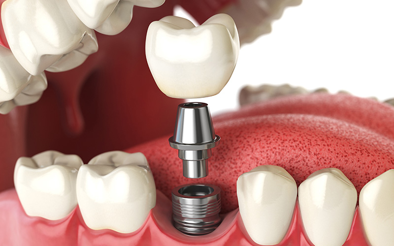 上部構造の作製・装着