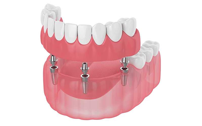 少ない本数で全体を支えるオールオン4（All-on-4）