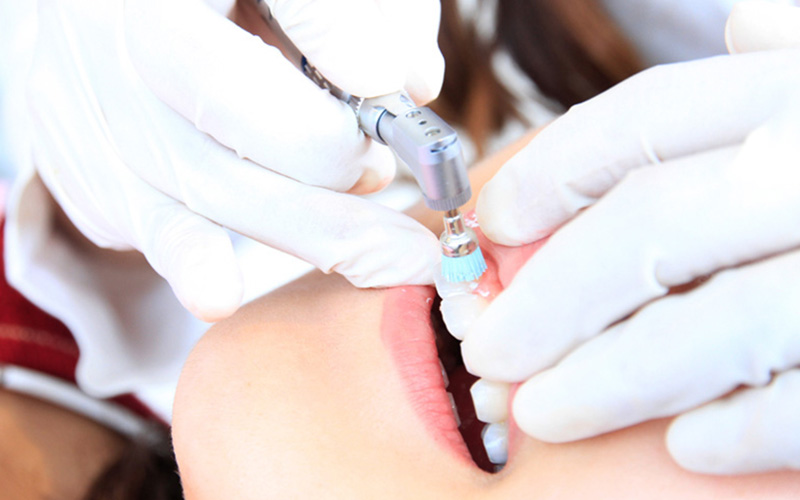 SRP（スケーリング・ルートプレーニング）