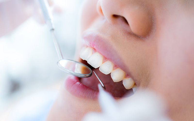 歯のクリーニング