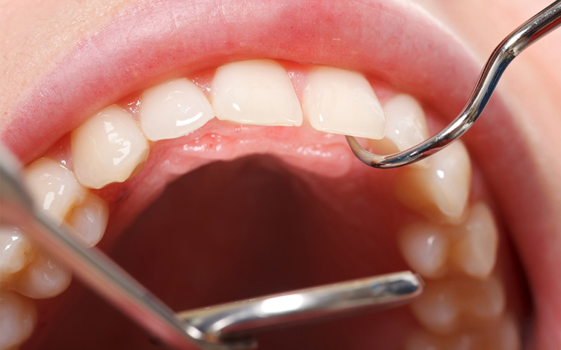 SRP（スケーリング・ルートプレーニング）