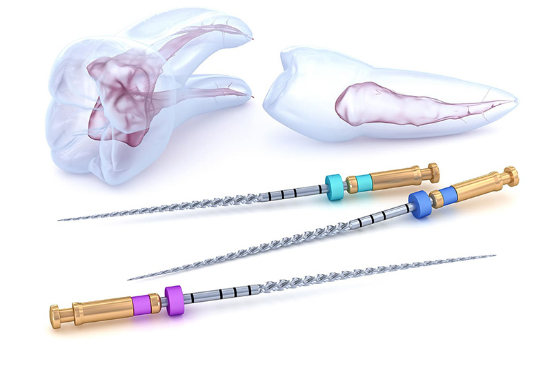 ニッケルチタンファイルによる根管清掃